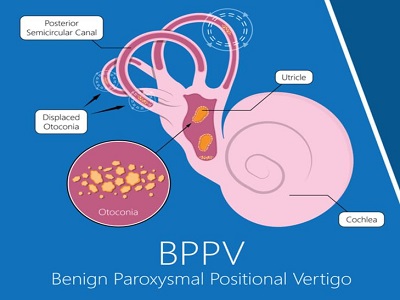 BPPV Treatment in Noida